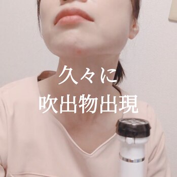 吹出物出現その1